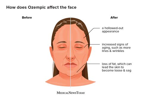 ozempic face side effects
